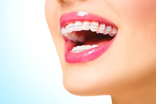 braces ceremic metal singapore dentist